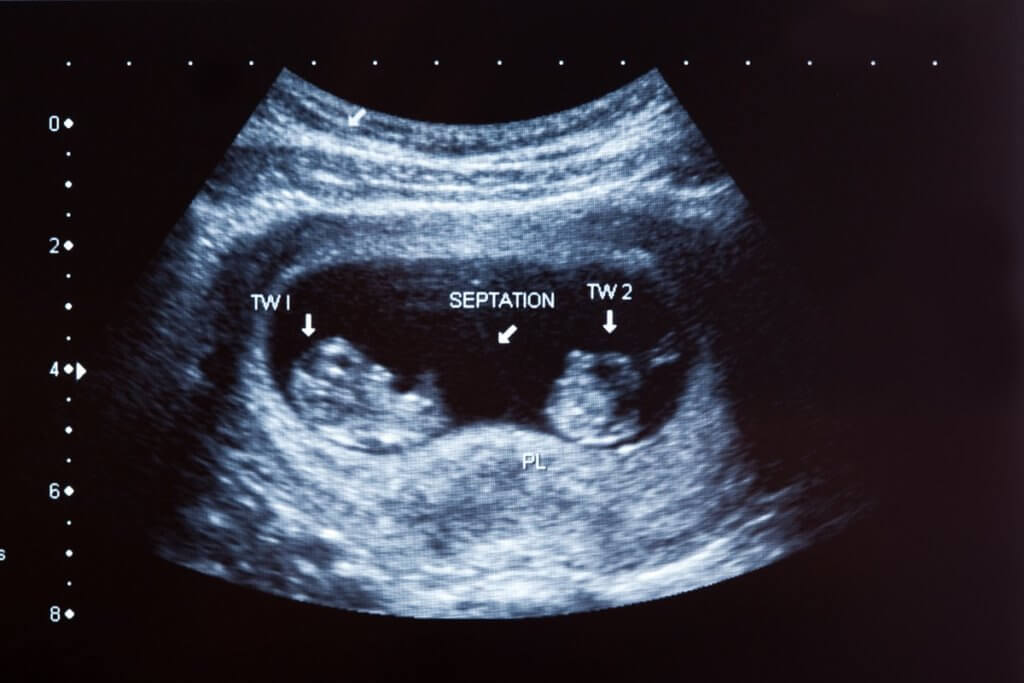 Ultrasound photo of twins