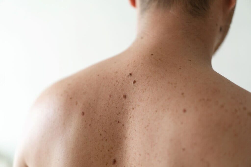 Skin Cancer Check WFMC Health